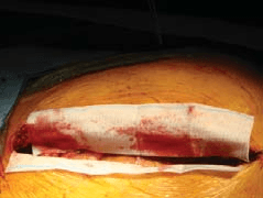 HemCon GuardaCare XR Surgical